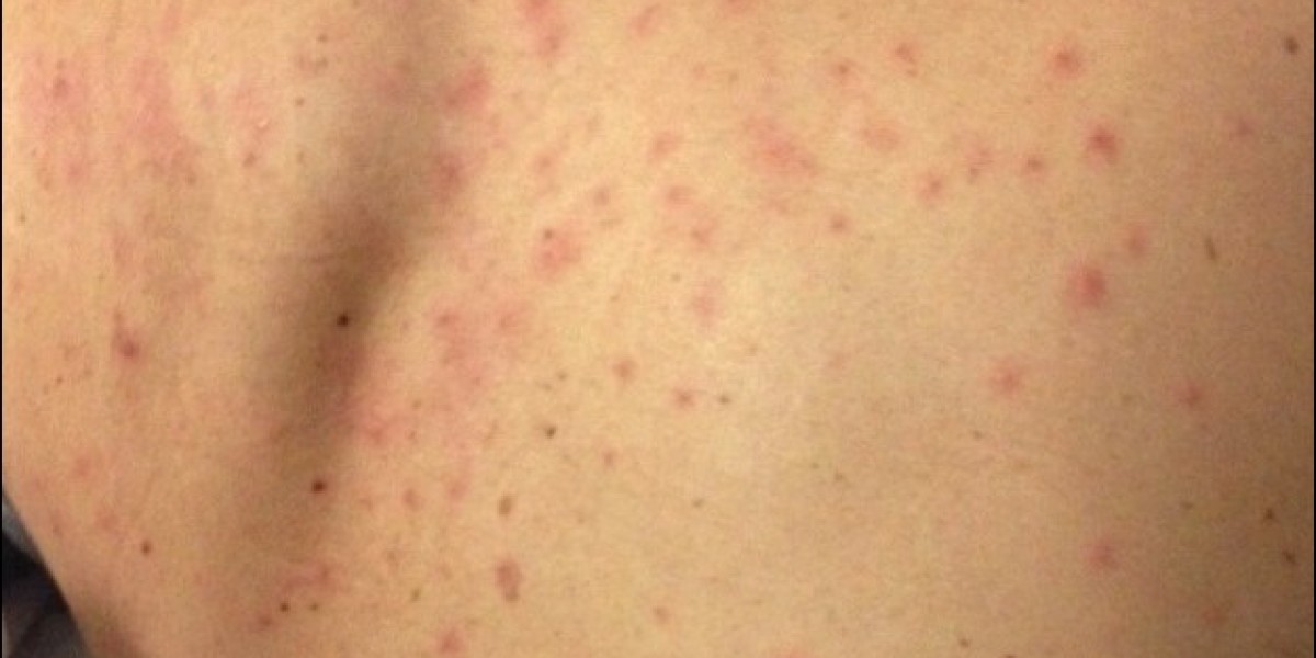 Hodgkin’s Lymphoma Market: Epidemiology, Size, Share, Analysis and Forecast till (2024-2034)