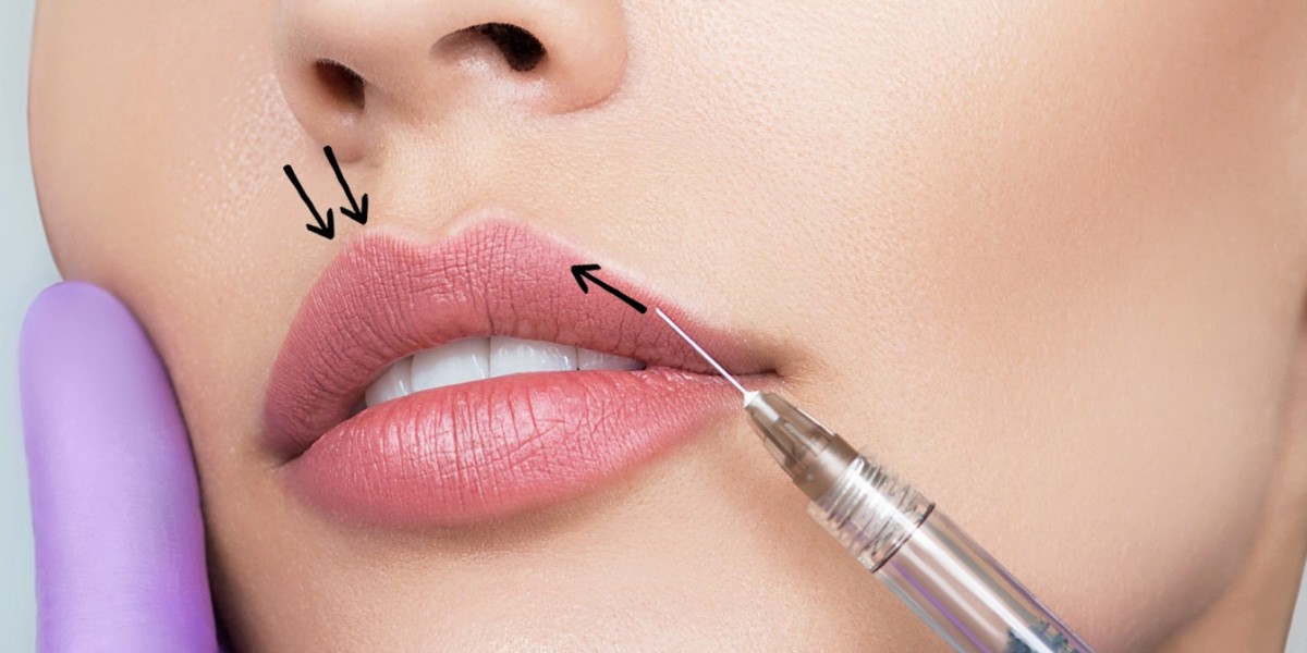 Russian Lip Fillers: A Modern Take on Lip Enhancemen