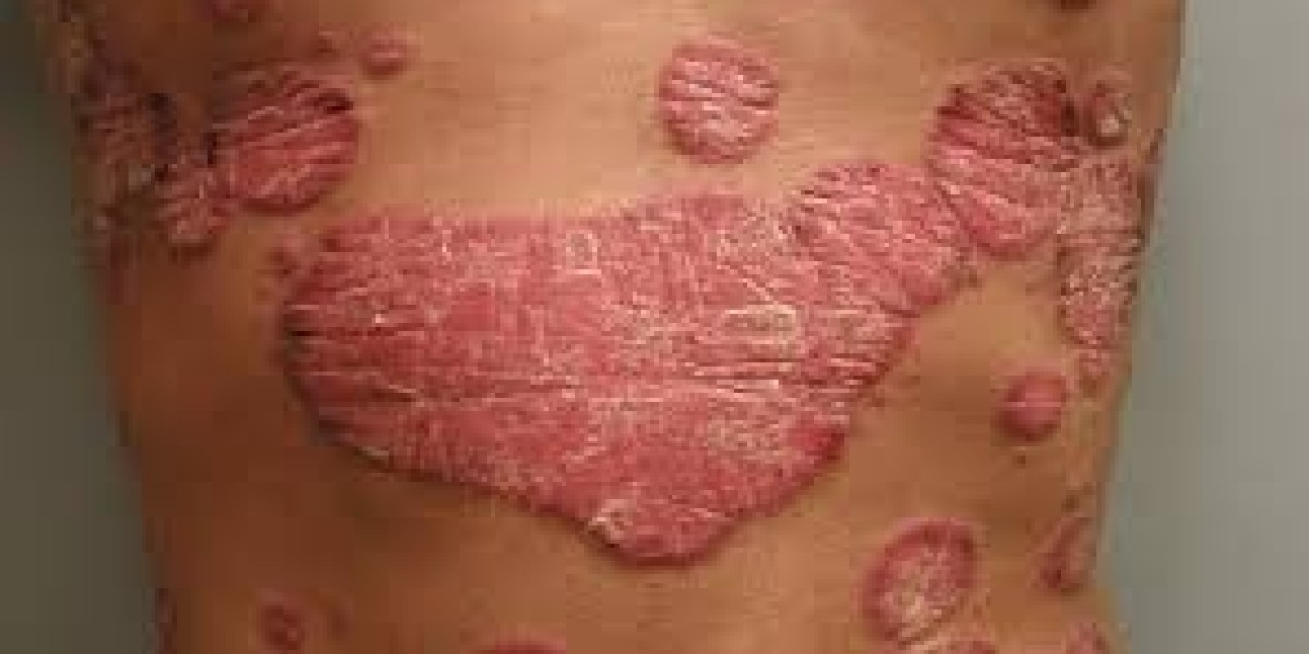 Clear Skin Ahead: Explore Top Psoriasis Treatment Choices