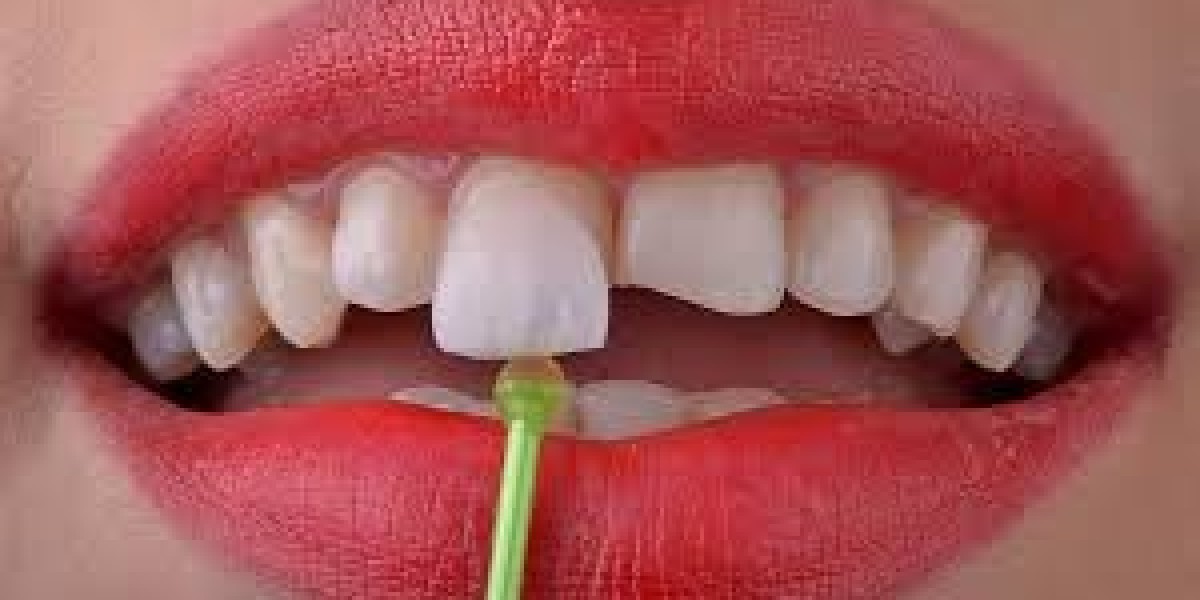 E-Max Veneers: The Most Advanced Choice for Dental Veneers