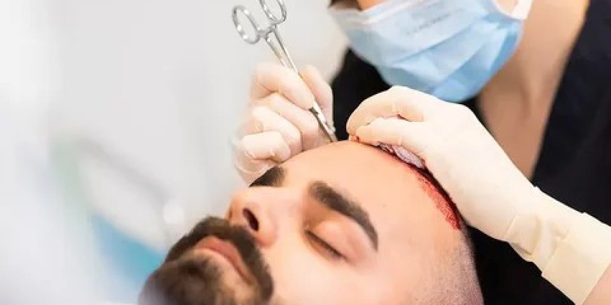 Why Are Hair Transplants in Dubai Expensive? Understanding the Factors