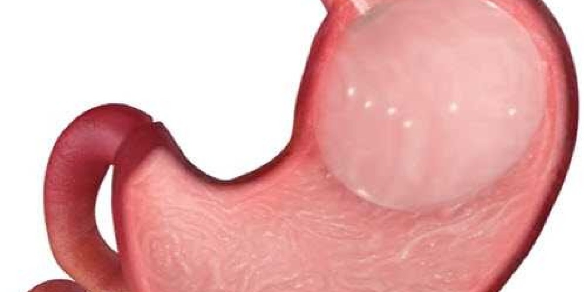 Transform Your Life with Gastric Balloon Surgery: What You Need to Know
