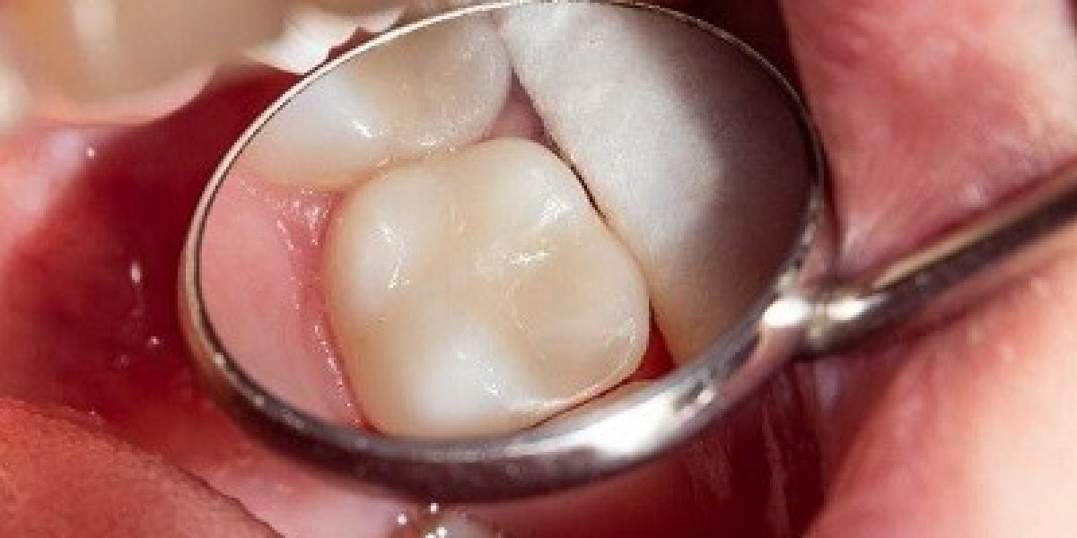 What to Expect During and After a Tooth Filling Procedure in Duba