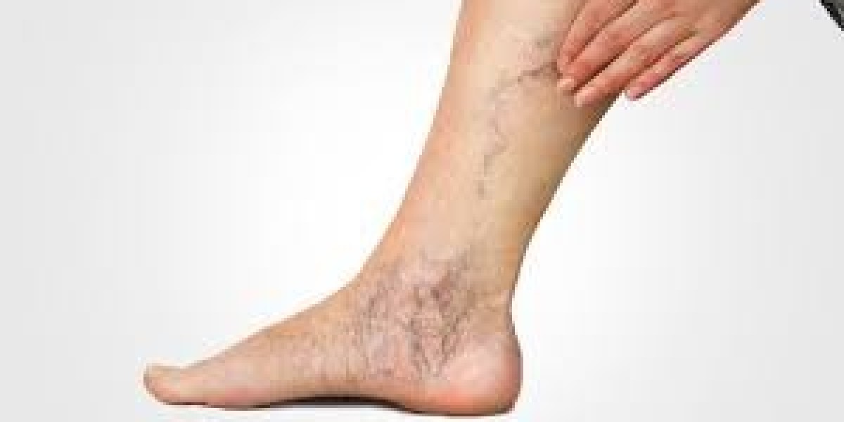 Effective Varicose Veins Relief: Your Riyadh Treatment Options