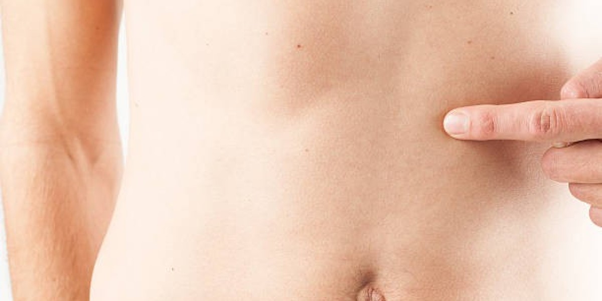 How to Prepare for Gallstone Surgery in Riyadh