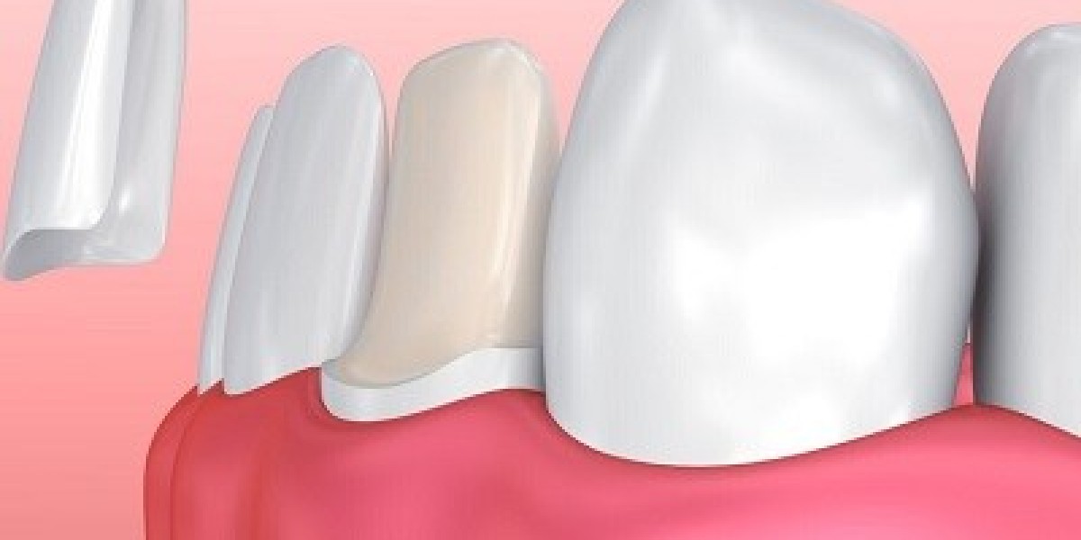 Why E-max Veneers Are Worth the Investment for Dubai Residents