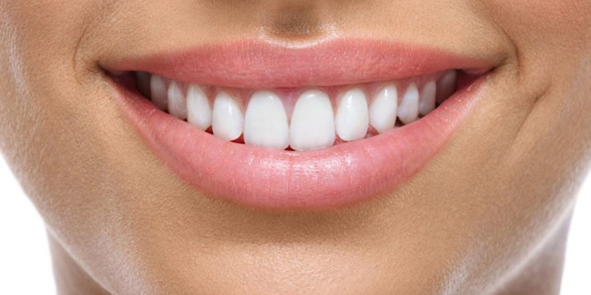 Unlock the Full Potential of Your Smile with E-Max Veneers