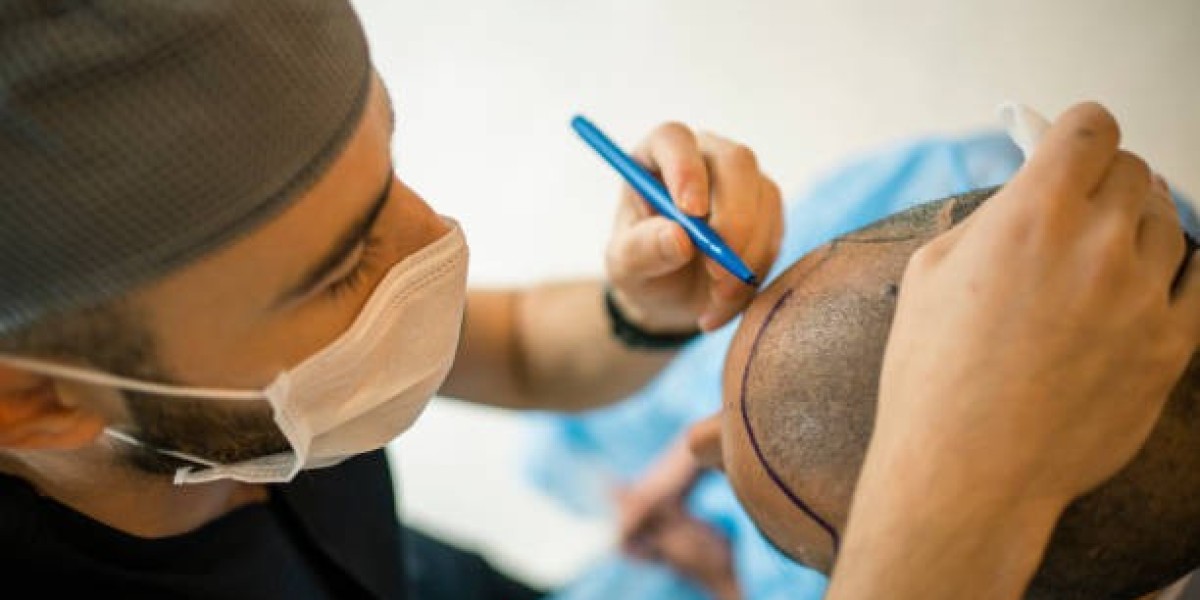 The Economics of Hair Transplant in Dubai: Understanding the Price Tag