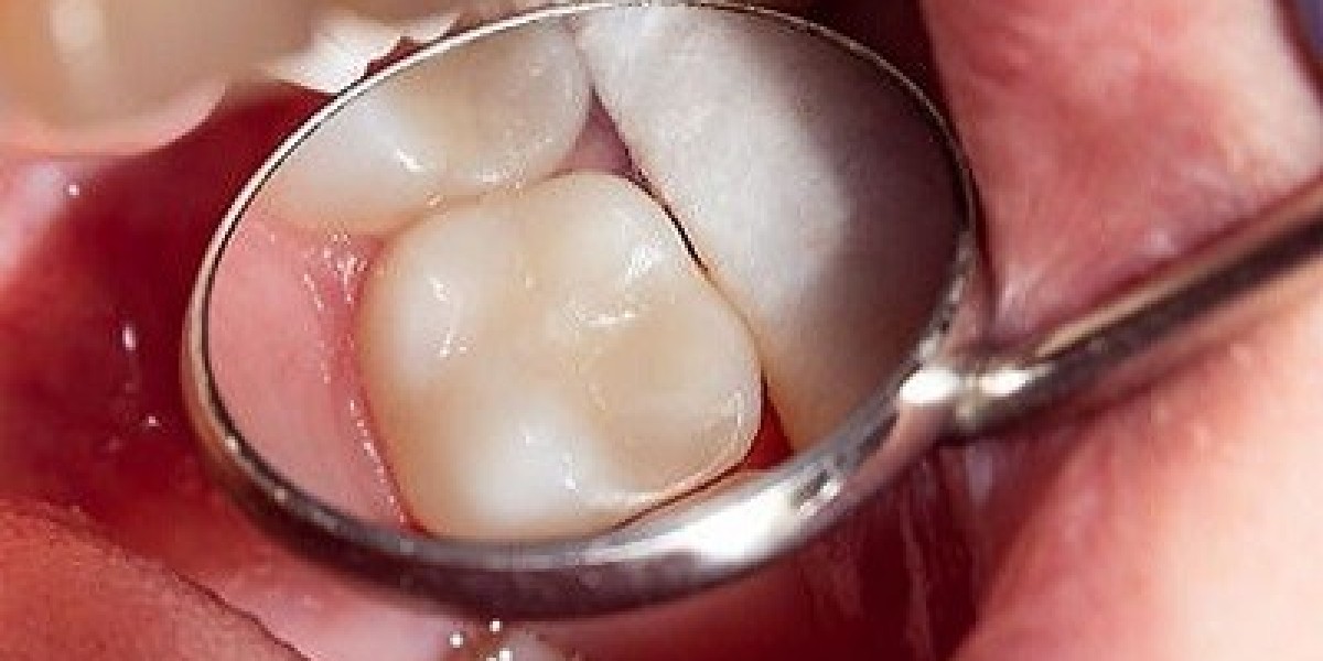 How Dental Fillings Can Prevent Further Tooth Decay
