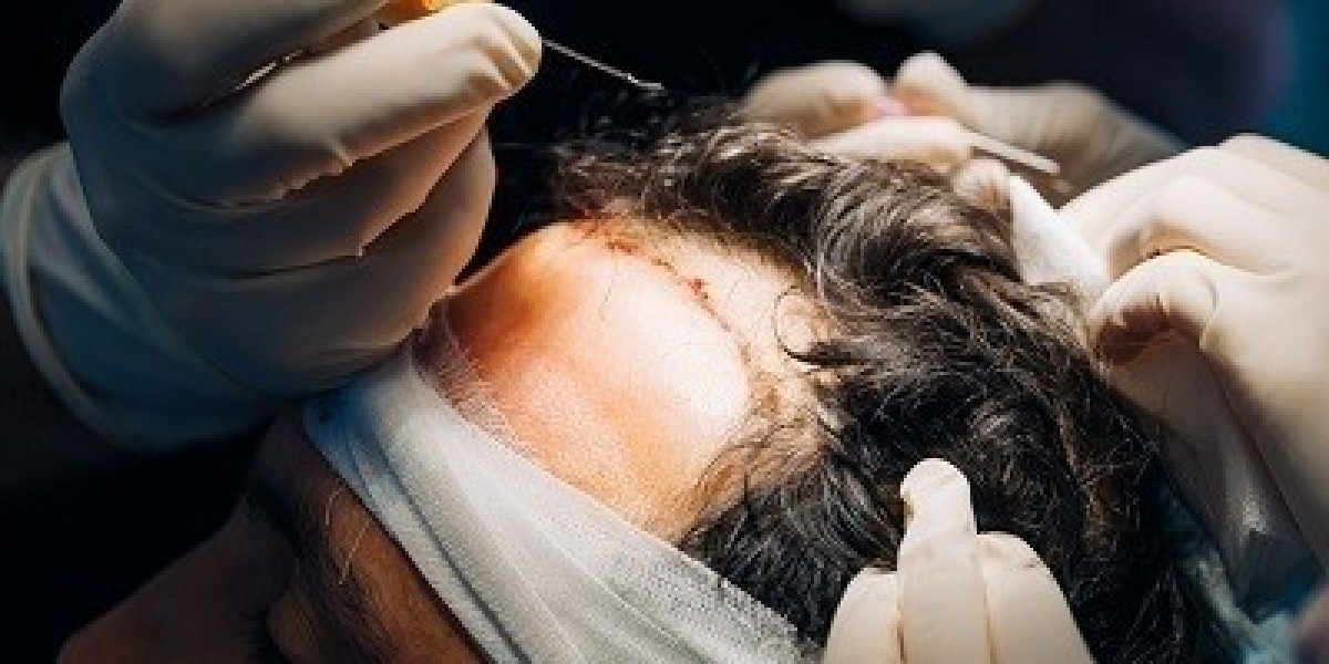 Can we comb transplanted hair?