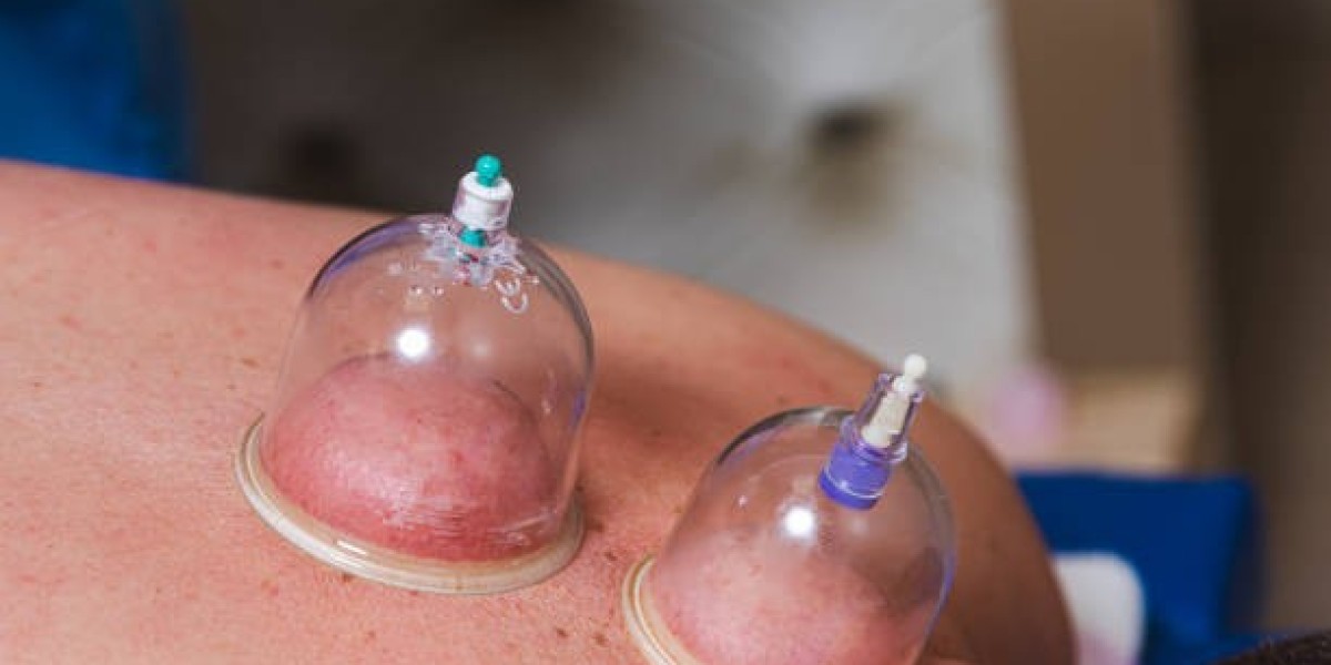 Cupping Treatment in Riyadh: A Natural Approach to Wellness