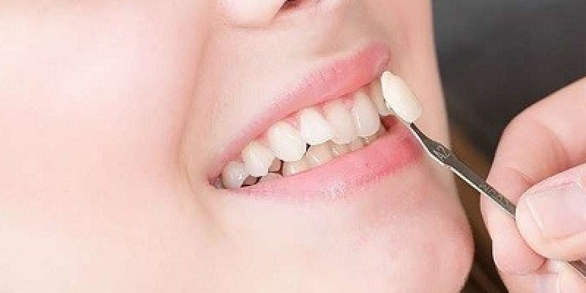 E-max Veneers for Teeth Gaps and Misalignments: Dubai's Expert Solutions