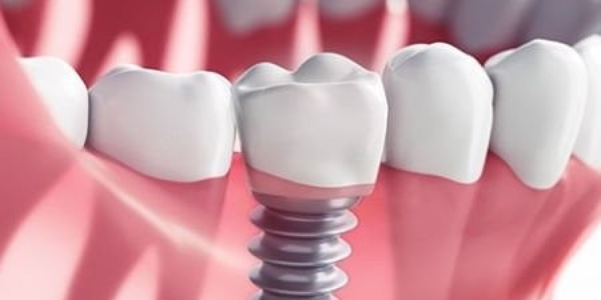 دليل شامل لزراعة الأسنان في دبي: التكاليف والإجراءات وفترة التعافي