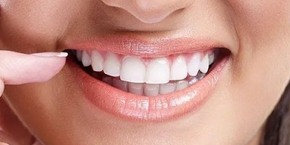 Maintaining Your E-max Veneers: Tips from Dubai Dentists for Longevity and Shine