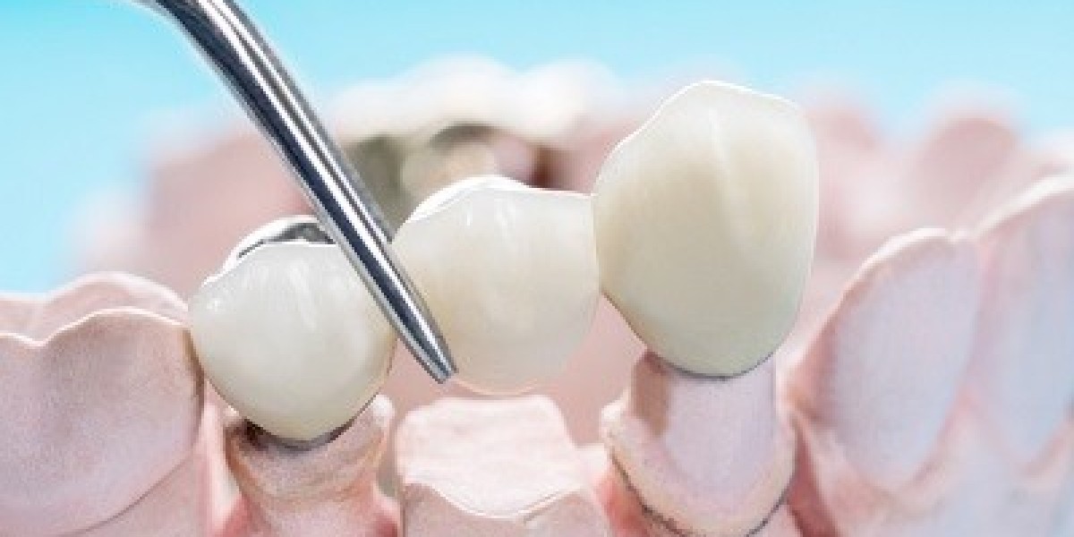 Dental Crown Procedure Explained in Islamabad