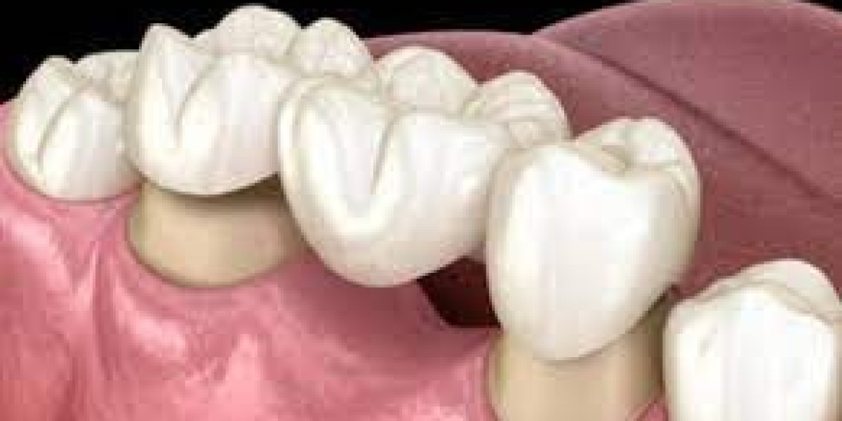 The Future of Dental Crowns and Bridges: Emerging Trends in Dubai