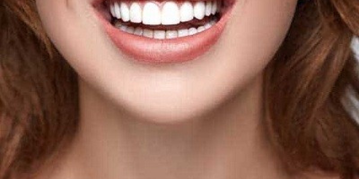 E-Max Veneers: A Solution for Dubai's Diverse Smile Needs