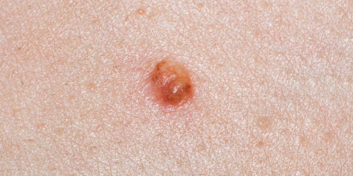 Why Choose Incision and Drainage for Abscesses in Riyadh?
