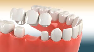 Dental Crowns and Bridges | Fillings ...