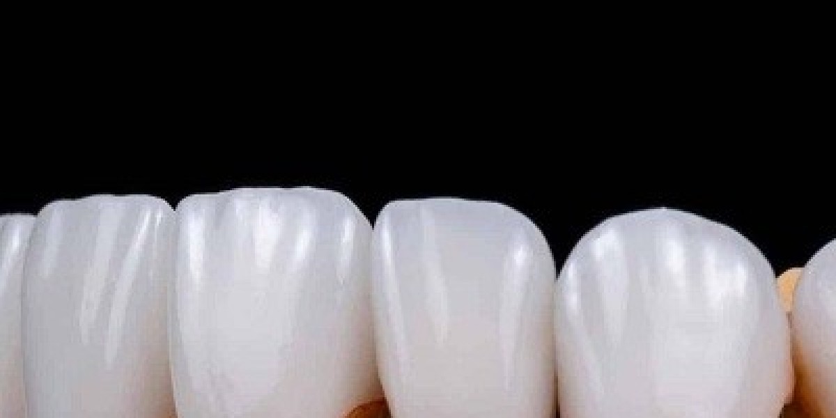 The Role of E-max Veneers in Comprehensive Smile Makeovers