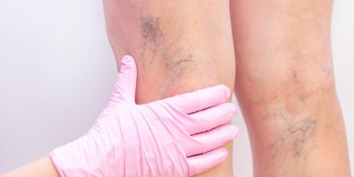 Varicose Veins Treatments: Benefits and Beyond
