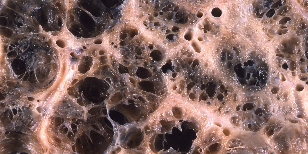 Emphysema Market Report: Epidemiology, Trends and Forecast to (2024-2034)