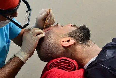تكلفة زراعة الشعر في دبي