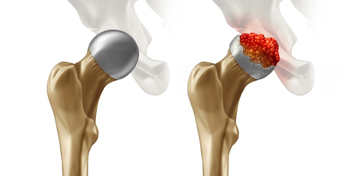 Hip Replacement Market Size, Share, In-Depth Insights, Analysis and Forecast 2024-2032