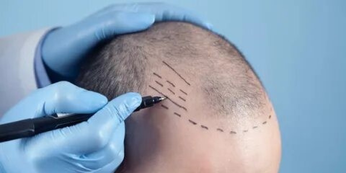 Hair Transplant in Dubai: Understanding the Price vs. Quality Trade-Off