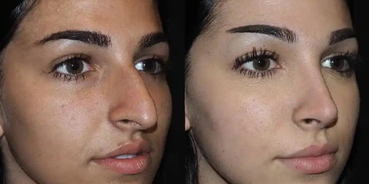How to Address a Narrow Nose with Rhinoplasty