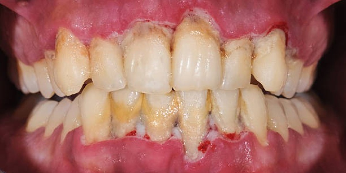 Say Goodbye to Gaps with a Dental Bridge in Riyadh