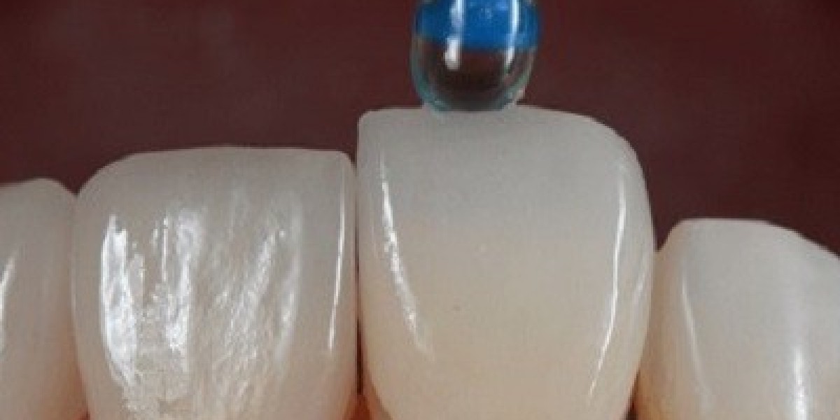 Choosing the Right E-max Veneer Provider in Dubai: What to Look For