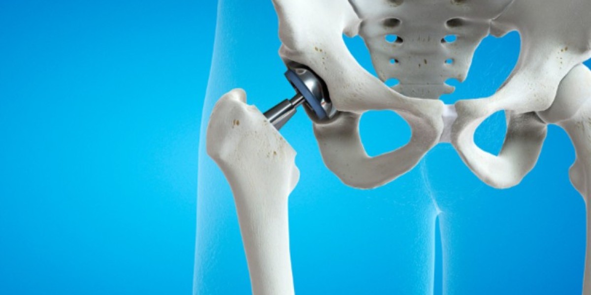 Global Orthopaedic Digit Implants Market | Share | Size | Reports | Forecast | 2024 - 2032