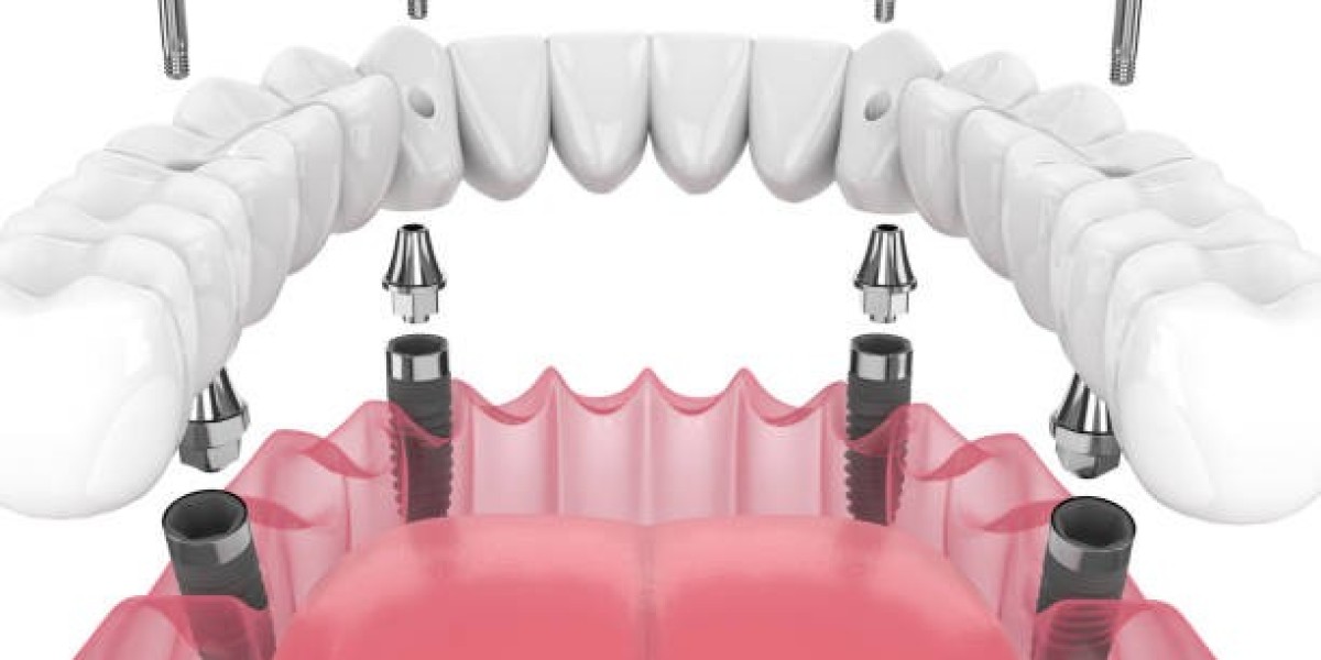Is a Dental Bridge in Riyadh Right for You? Key Considerations