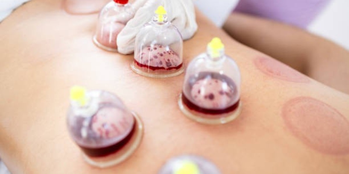 Discover the Magic of Cupping Therapy in Riyadh