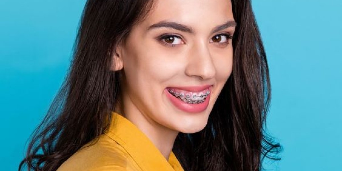 Looking for Metal Braces in Riyadh? Here's What You Should Know