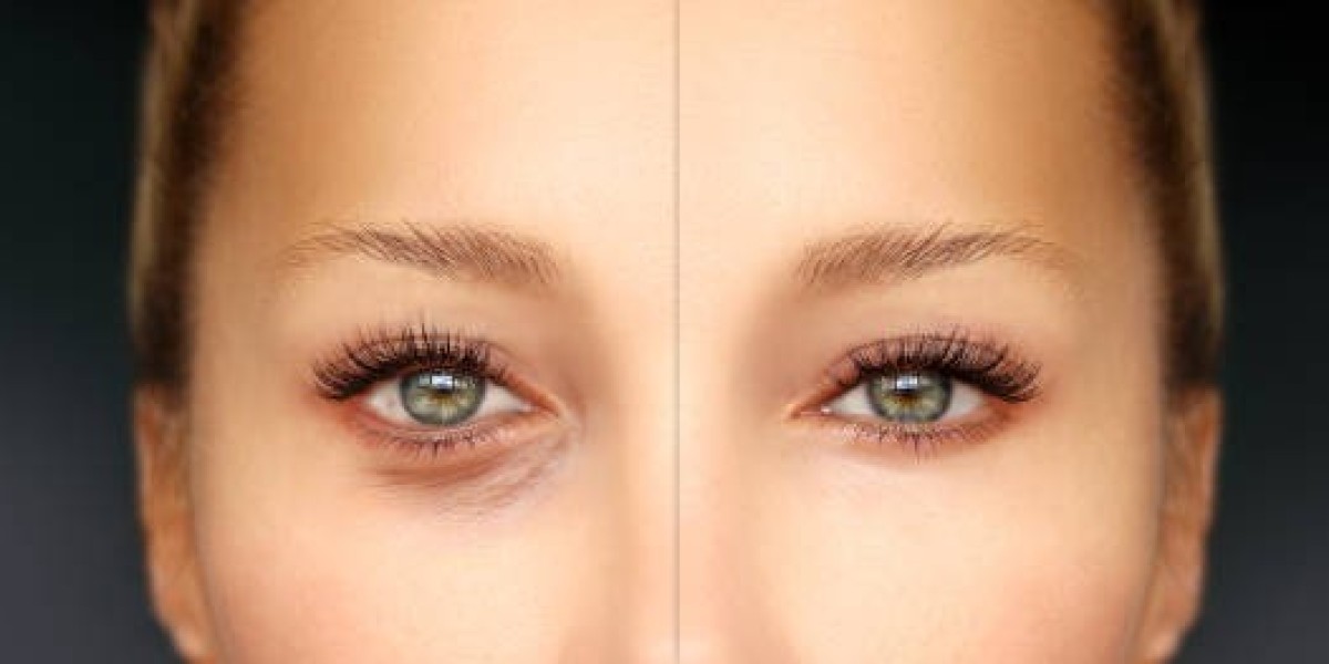 Redefine Your Look with The Eyelid Surgery in Riyadh
