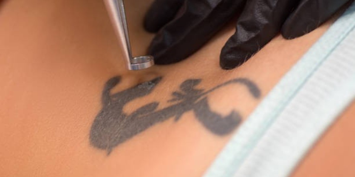 Erase, Renew, and Revive: Laser Tattoo Removal in Riyadh