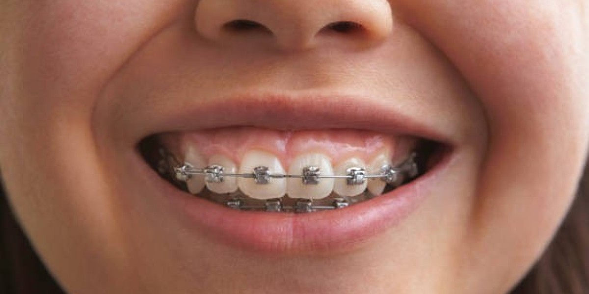 Discover the Power of a Perfect Smile with Orthodontics in Riyadh