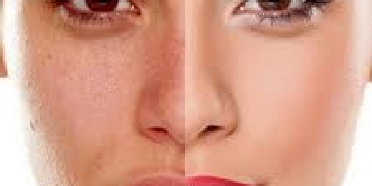 Chemical Peels Cost in Dubai: Are They Expensive for Acne Treatment