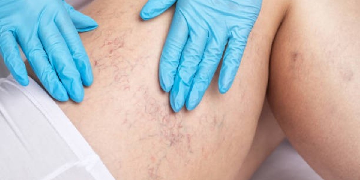Managing Risk Factors: How Vascular Surgery in Riyadh Helps