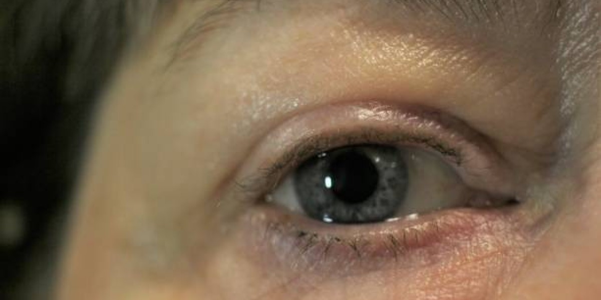 Say Goodbye to Eye Bags: Your Ultimate Guide to Removal in Riyadh
