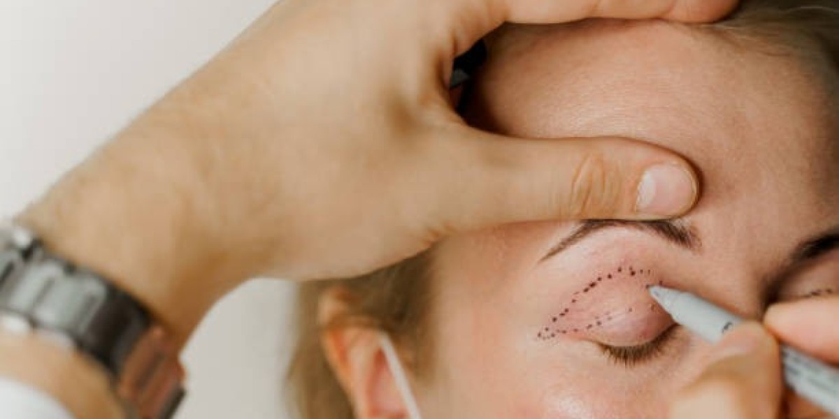 Get the Sparkling Eyes You Desire with Riyadh’s Best Eyelid Surgery Doctor