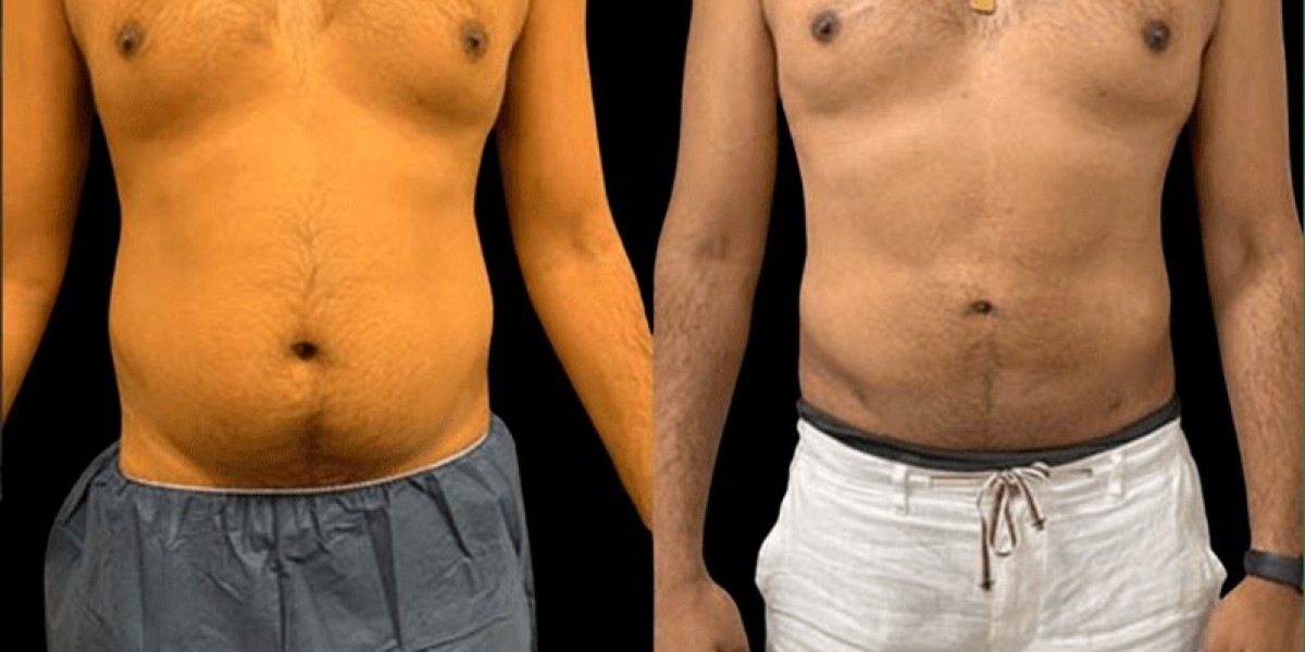 Mounjaro Injection Dubai: Innovative Approach to Weight Loss