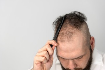 زراعة الشعر في دبي