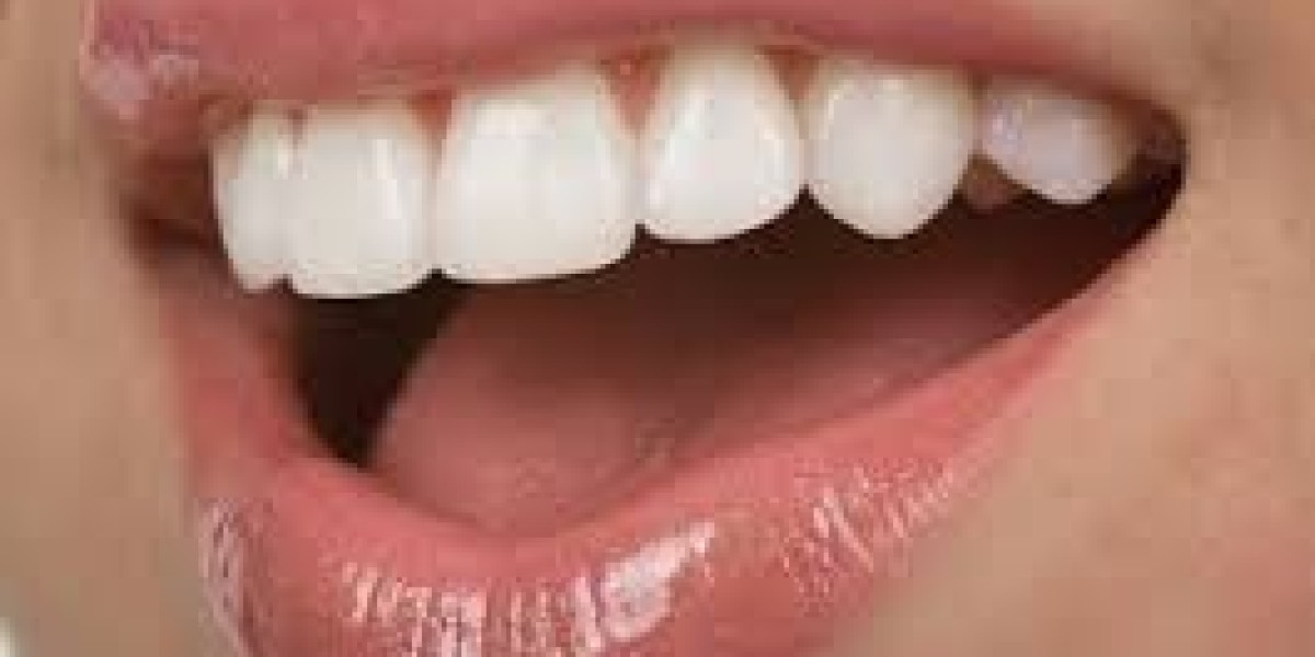 Is Your Smile Ready for E-Max Veneers in Riyadh? Find Out!