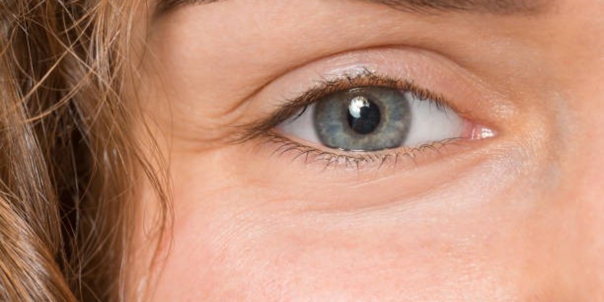 The Connection Between Allergies and Eye Bags: Removal Strategies
