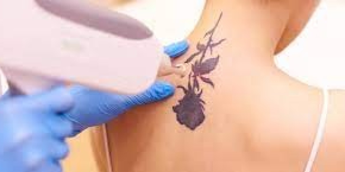 Recovery Period of Laser Tattoo Removal