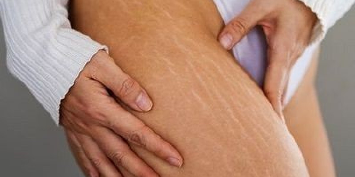 A Step-by-Step Guide to Laser Stretch Marks Treatment in Dubai
