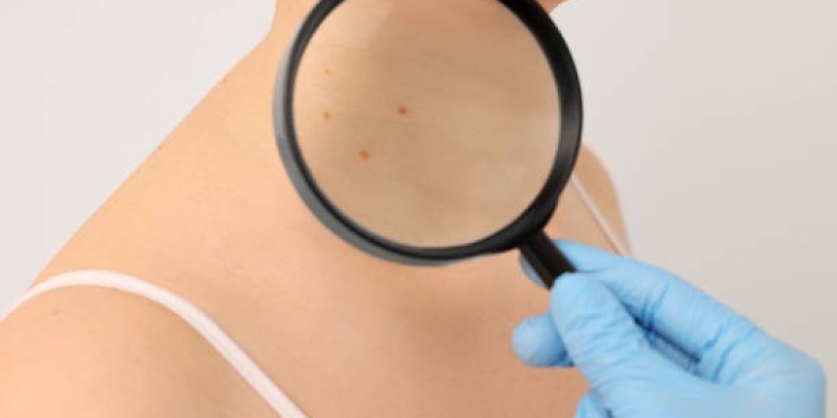 Your Complete Resource for Dermoscopy Mole Evaluation Insights